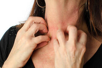 Comment prevenir l'eczema ?