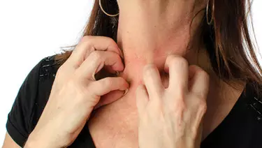 Comment prevenir l'eczema ?