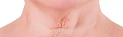 Close-up of a person's neck showing prominent wrinkles and creases in the skin.