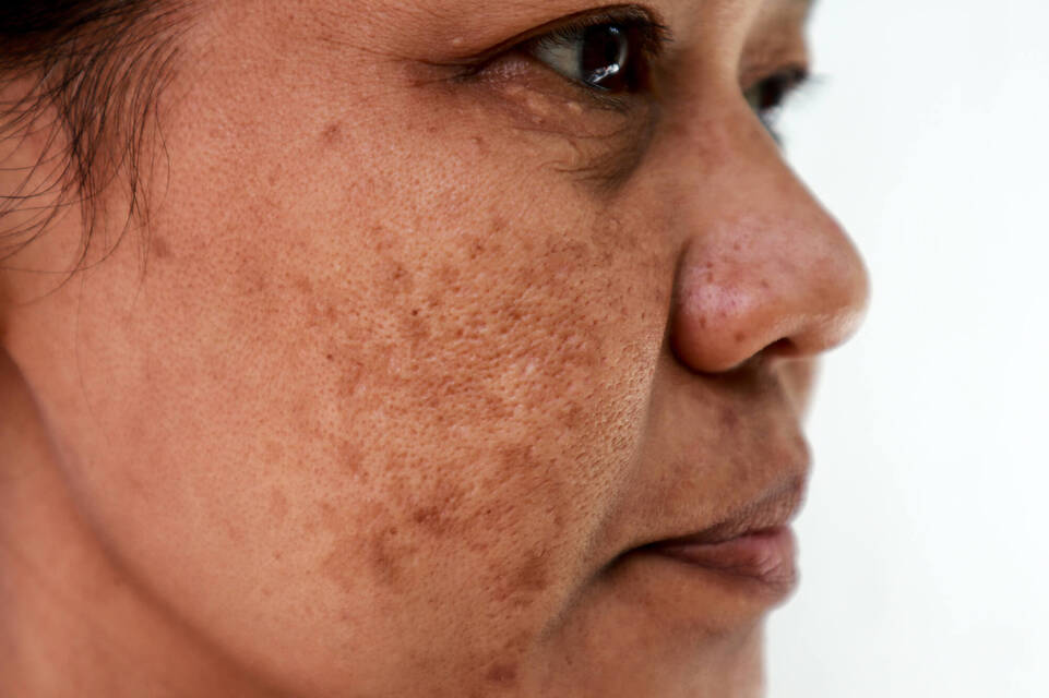 Creme solaire : pourquoi aide-t-elle a lutter contre le vieillissement de la peau ?