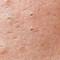 Close-up of human skin showing pores and texture, with small raised areas and blemishes.
