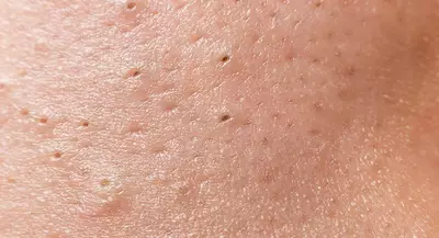 Close-up of human skin showing pores and texture, with small raised areas and blemishes.