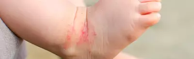 A close-up of a child's foot with visible red abrasions on the ankle and surrounding skin.