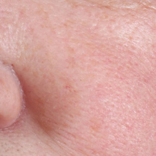 Acne