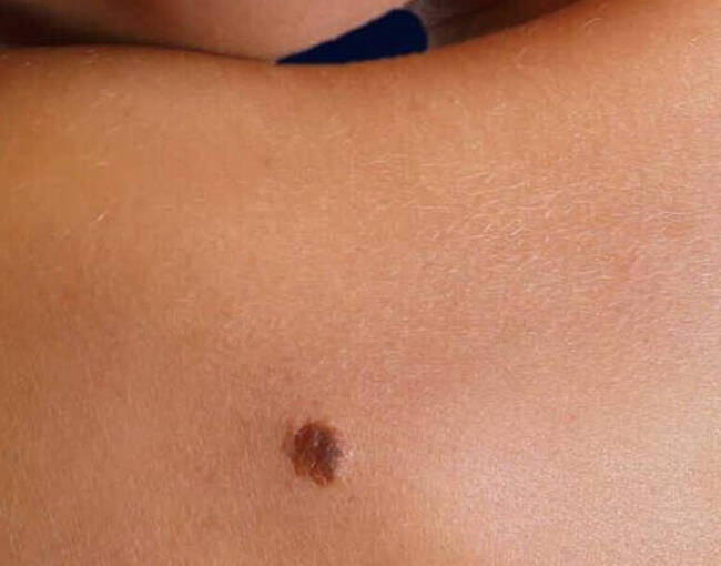 Melanoma Prevention Image