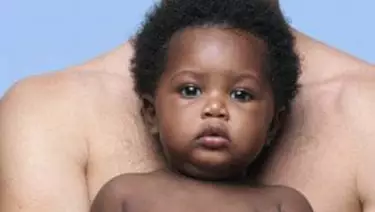 L'eczema chez les bebes et les enfants