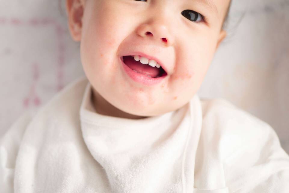 Causes de l’eczema