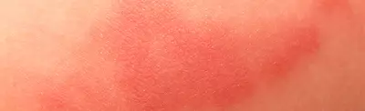 Close-up image of skin showing a textured, slightly red area, possibly indicating irritation or a rash.