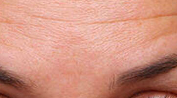 Close-up of a person's forehead, showing fine lines and smooth skin around the eyebrows and eyes.