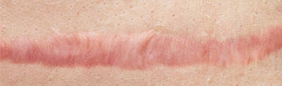 Close-up view of a pinkish scar on a textured skin surface.
