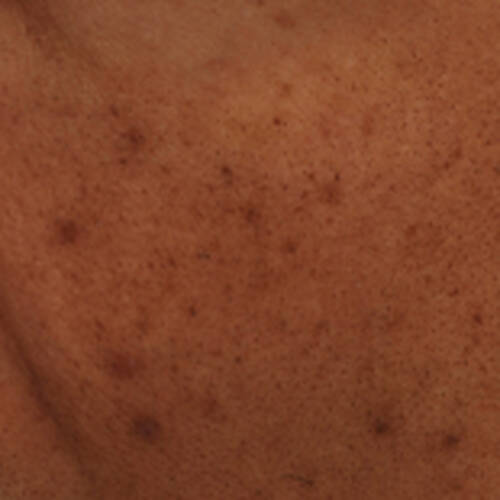 Acne