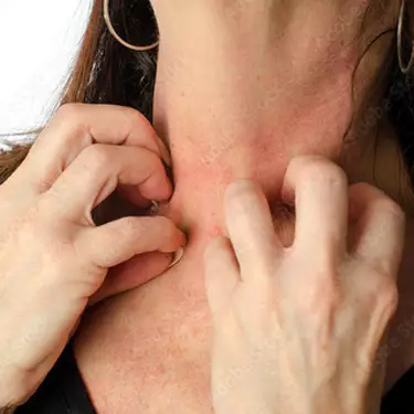 Comment prevenir l'eczema