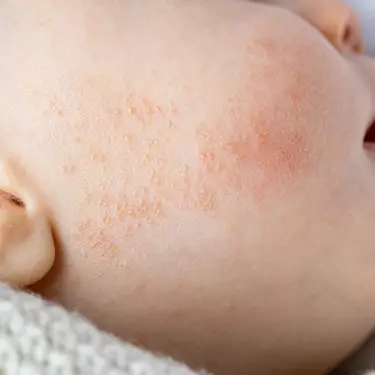 L'eczema chez les bebes et les enfants