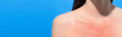 A close-up of a woman's shoulder and neck area with visible redness and irritation on the skin, set against a bright blue background.