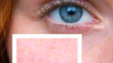 A close-up of a person's eye with striking blue irises and long eyelashes, accompanied by an inset showing a section of skin texture with a smooth, pinkish tone.