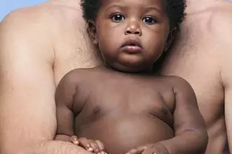 L'eczema chez les bebes et les enfants