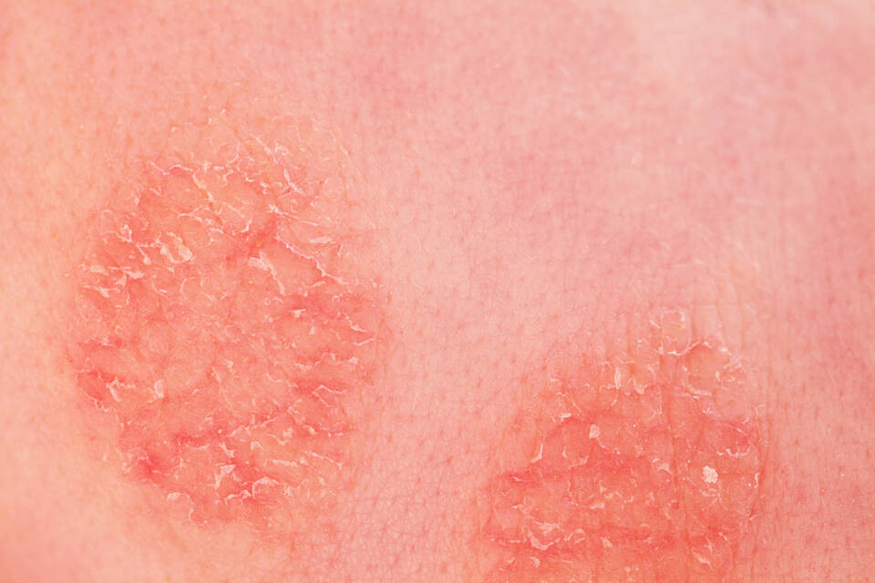 Quels sont les symptomes de l’eczema atopique