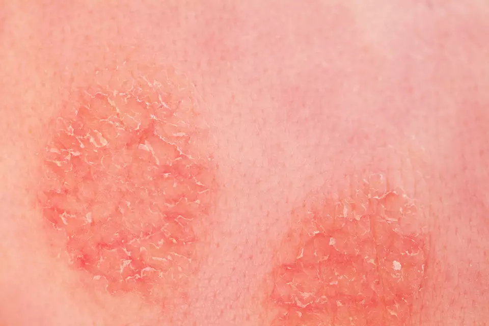 Quels sont les symptomes de l’eczema atopique