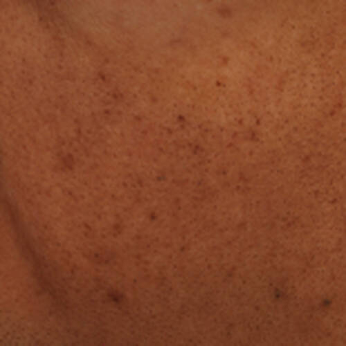 Acne