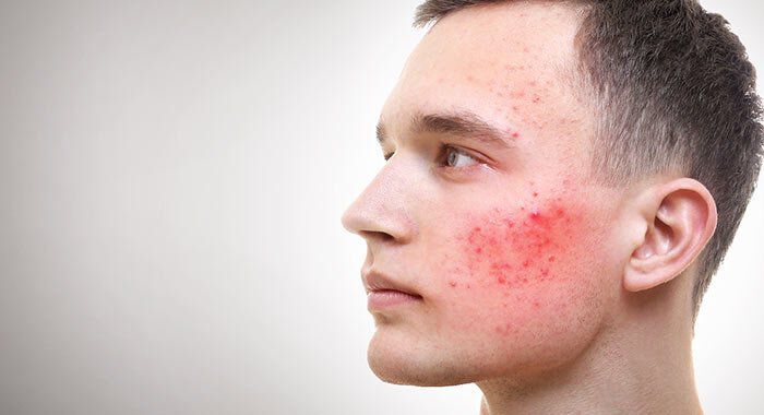 A side profile of a young man with red, inflamed acne on his cheek, set against a neutral background.