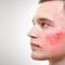A side profile of a young man with red, inflamed acne on his cheek, set against a neutral background.