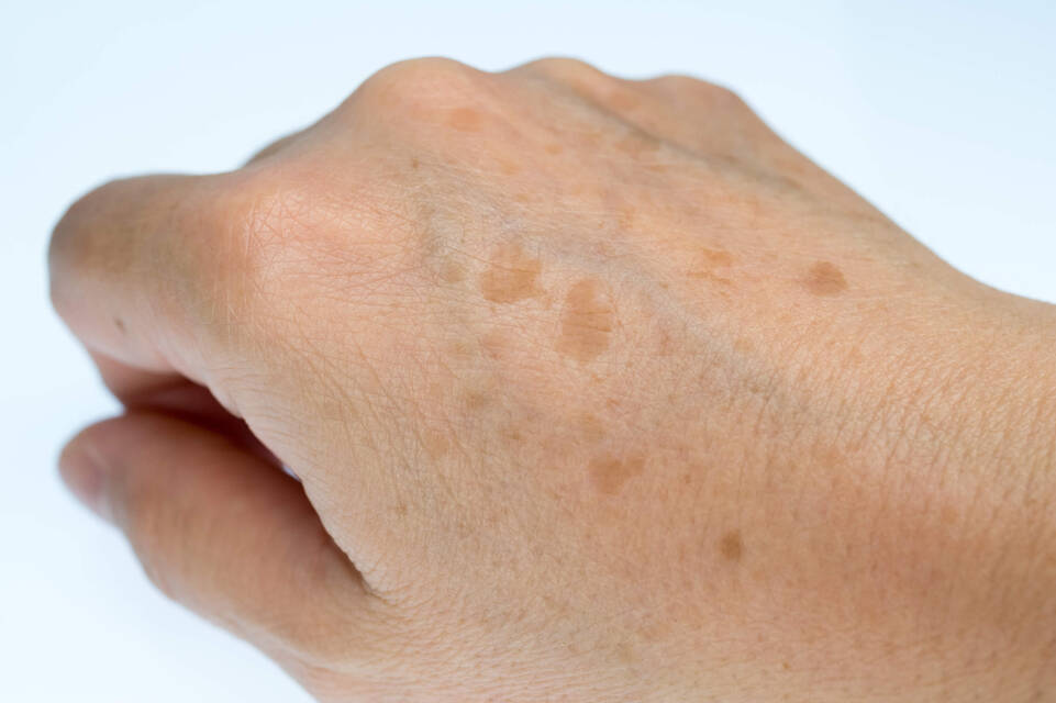Taches brunes sur les mains : comment les enlever ? | La Roche-Posay