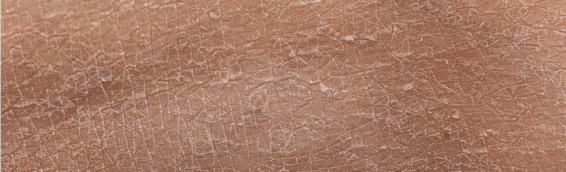 Close-up of dry, cracked skin texture, showcasing a rough and peeling surface.