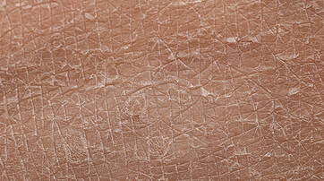 Close-up of dry, cracked skin texture, showcasing a rough and peeling surface.