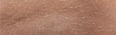 Close-up of dry, cracked skin texture with visible scales and irregular patterns.