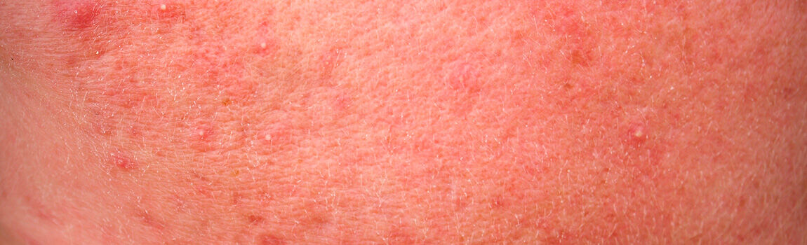 Close-up image of skin with a reddish hue and small raised bumps, indicating irritation or a dermatological condition.
