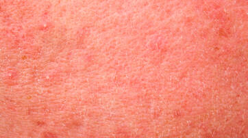 Close-up image of skin with a reddish hue and small raised bumps, indicating irritation or a dermatological condition.