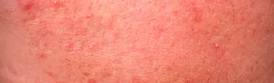 Close-up of skin showing redness and small bumps, indicating a possible skin condition.