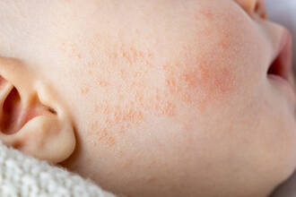 L'eczema chez les bebes et les enfants