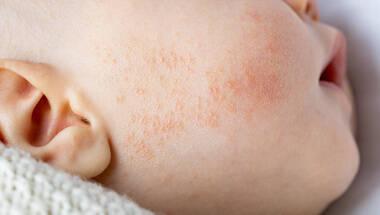L'eczema chez les bebes et les enfants
