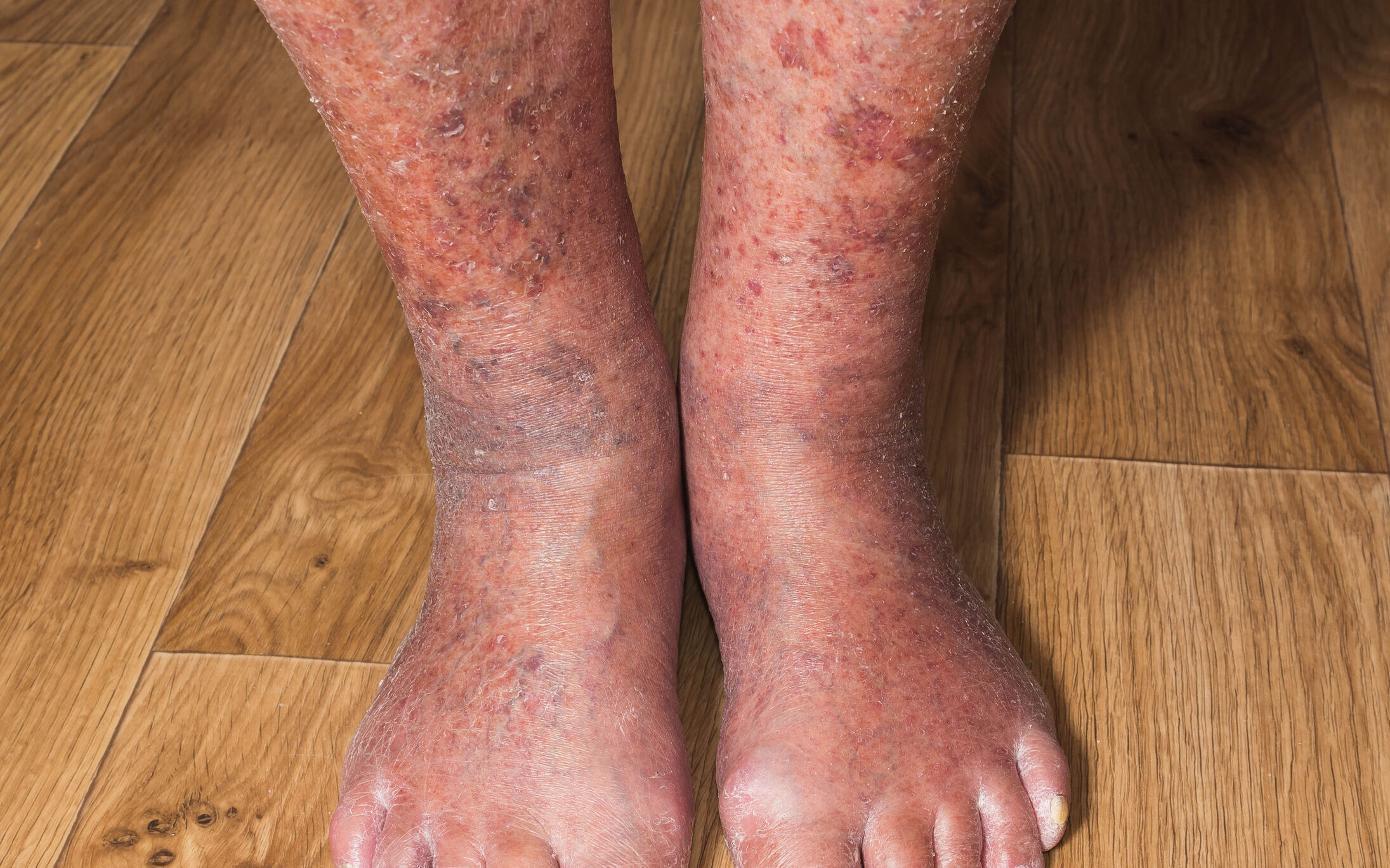 Jambes et pieds presentant une dermite ocre avec hyperpigmentation brun-rouge et gonflements cutanes.