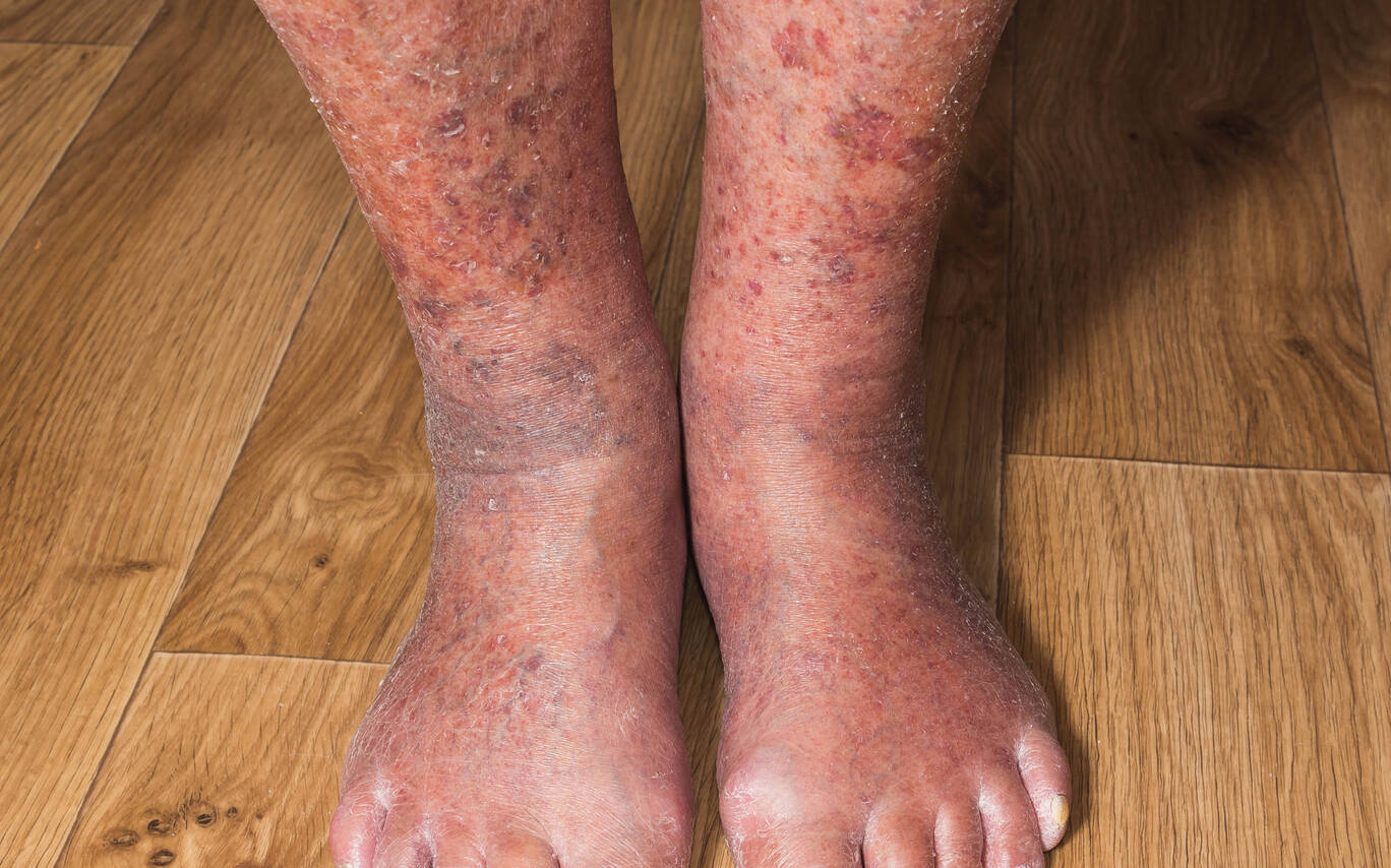 Jambes et pieds presentant une dermite ocre avec hyperpigmentation brun-rouge et gonflements cutanes.