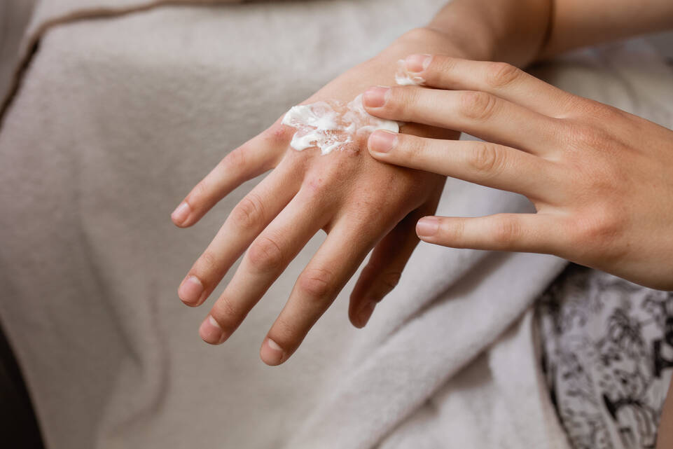 Eczema atopique et eczema chronique des mains