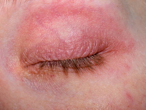 Plaques Rouges Sur La Paupiere Eczéma des paupières : Reconnaître et Soulager | La Roche Posay