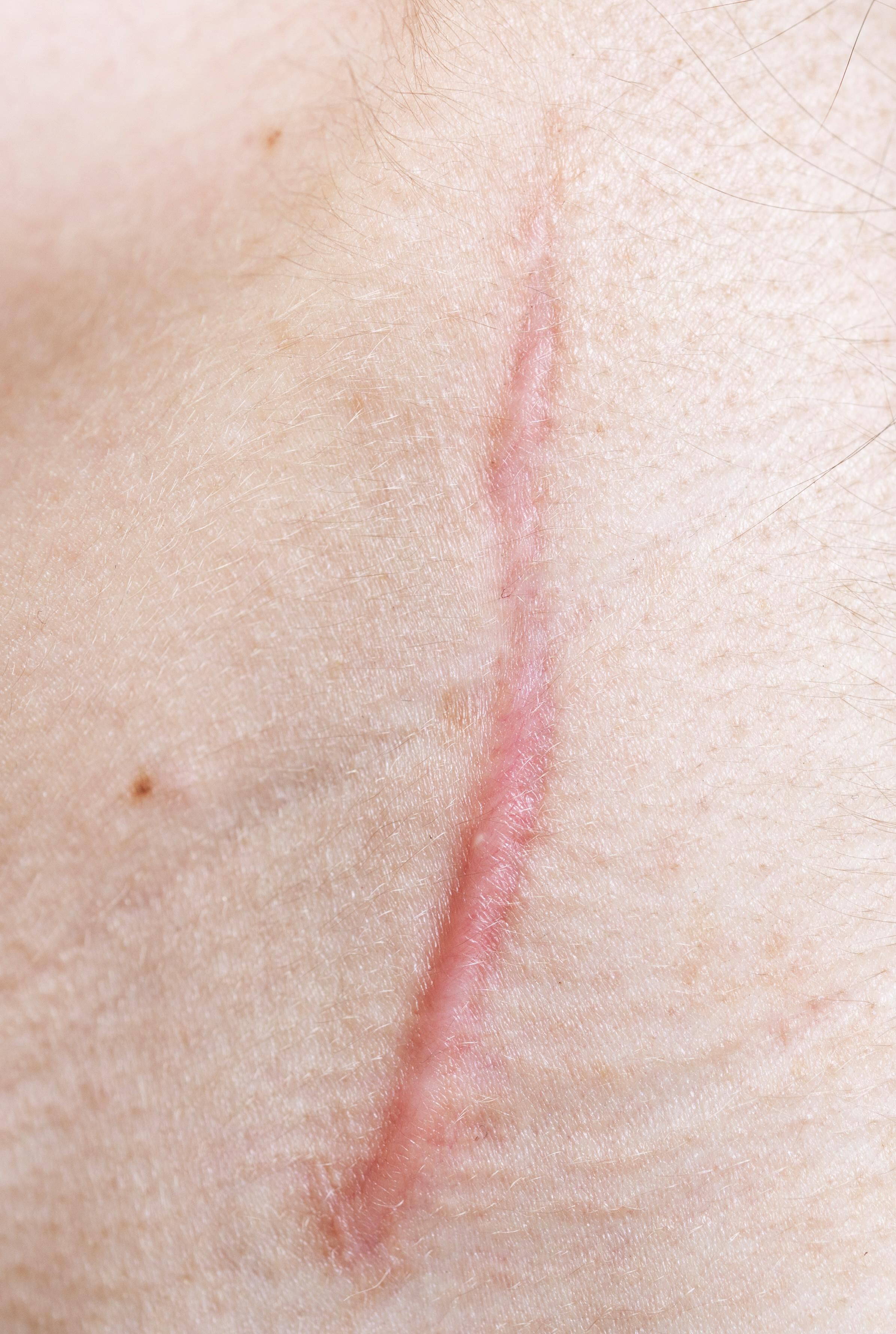 Une cicatrice rougeatre sur la peau, visible sur une zone claire.