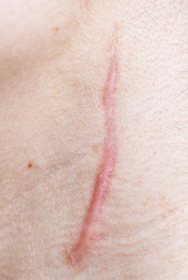 Une cicatrice rougeatre sur la peau, visible sur une zone claire.