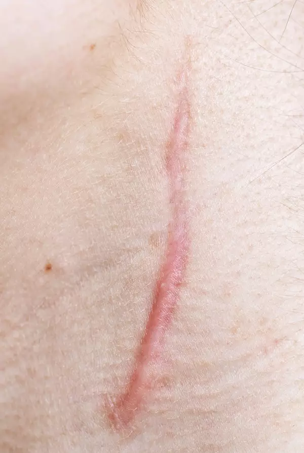 Une cicatrice rougeatre sur la peau, visible sur une zone claire.