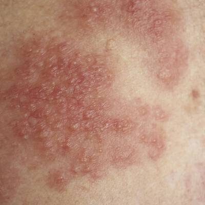 Une photographie en gros plan d'une eruption cutanee rouge et bosselee, presentant plusieurs vesicules (petites cloques) remplies de liquide sur une zone de peau inflammee.