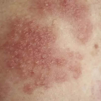 Une photographie en gros plan d'une eruption cutanee rouge et bosselee, presentant plusieurs vesicules (petites cloques) remplies de liquide sur une zone de peau inflammee.