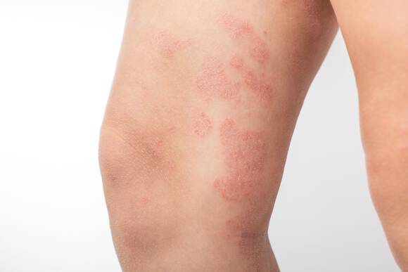 Eczema de contact