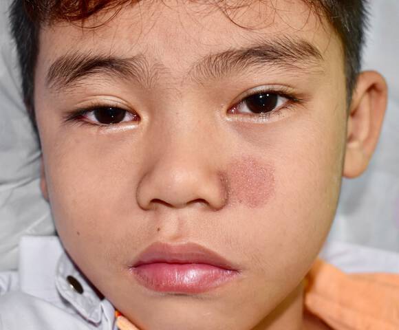 Eczéma visage : causes, symptômes et traitements | La Roche-Posay