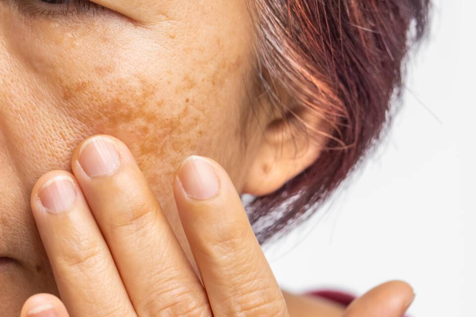 Causes de l’eczema