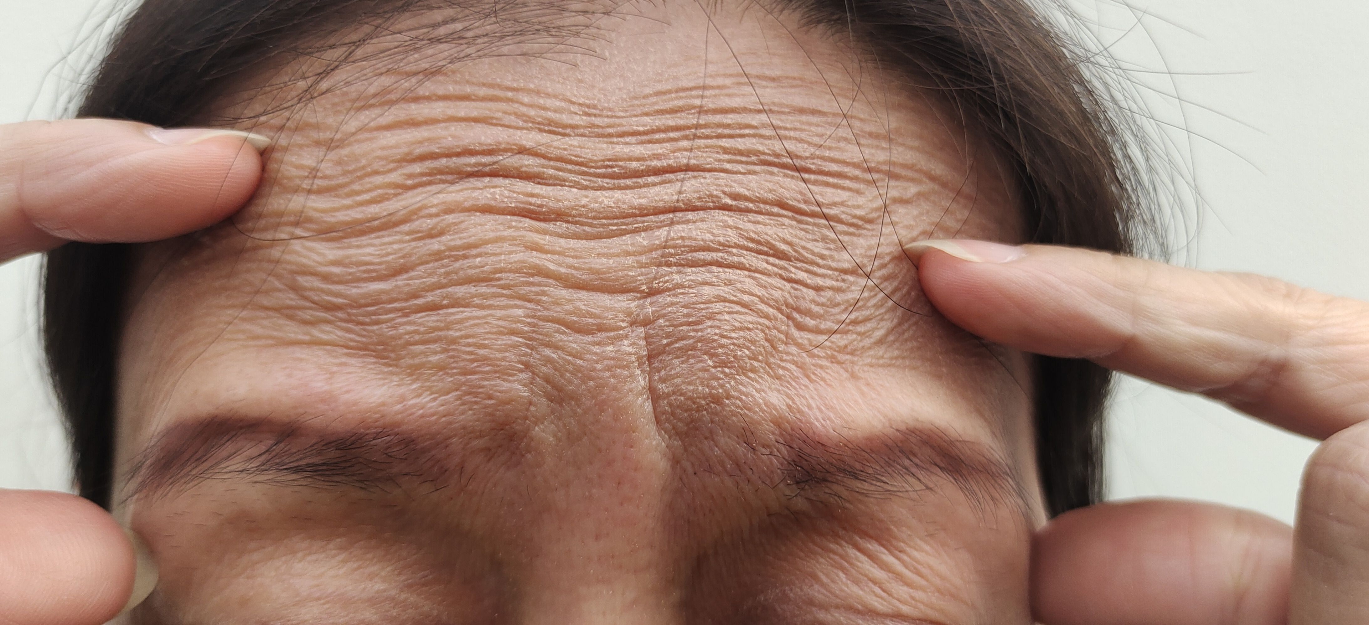 Une image en gros plan du front d'une personne montrant des rides d'expression horizontales profondes, avec des doigts pressant delicatement la peau pour en souligner la texture.