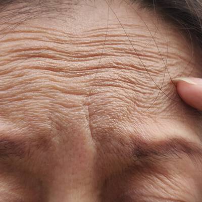Une image en gros plan du front d'une personne montrant des rides d'expression horizontales profondes, avec des doigts pressant delicatement la peau pour en souligner la texture.