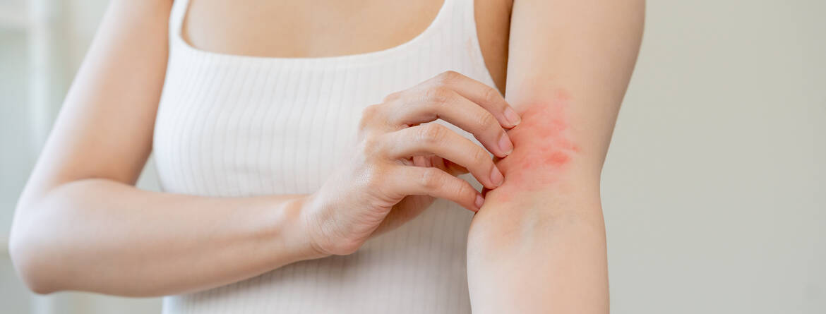Eczema des mains et des coudes