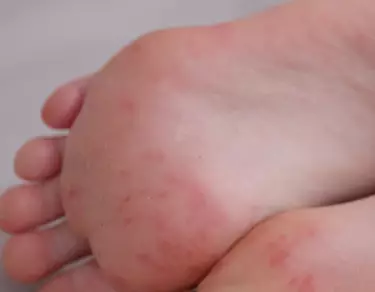 Eczema des pieds : causes, symptomes et traitements
